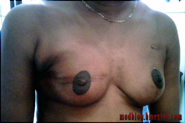 After - Tattooed Nipple Reconstruction