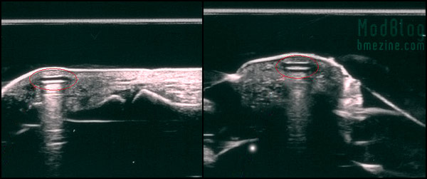 magnetic-implant-ultrasound.jpg