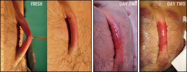 bipedicle-1-fresh-to-day-two