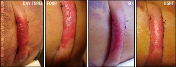 bipedicle-2-day-three-to-eight