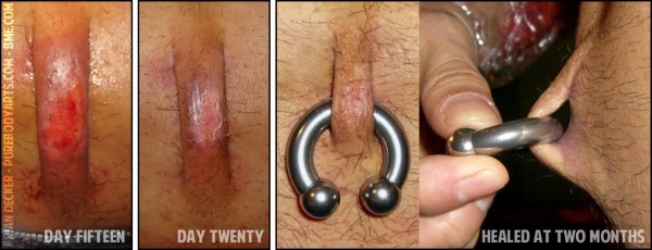 bipedicle-3-day-fifteen-to-two-months