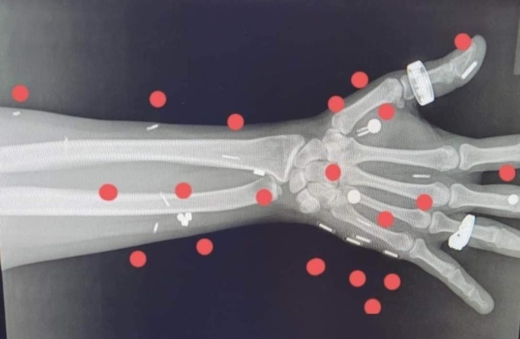 An X-ray focused on a person's wrist showing numerous implanted magnets and microchips.